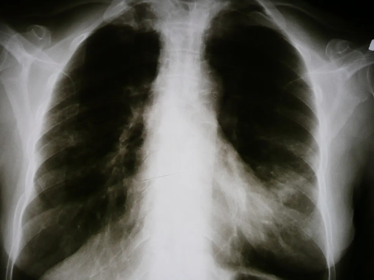 Pneumonia Detection from X-Ray project