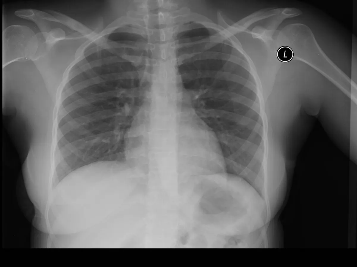Pneumonia Detection from X-Ray - Normal PA chest x-ray