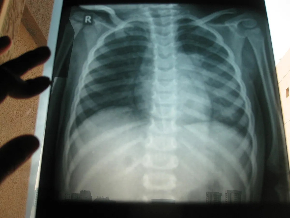 Pneumonia Detection from X-Ray - Chest x ray 1 year old by irvin calicut